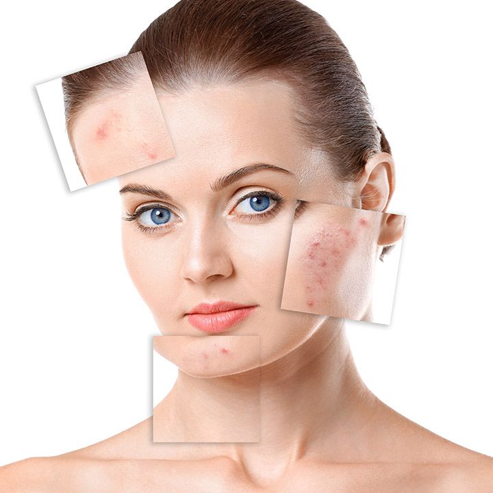 Skin Pigmentation
